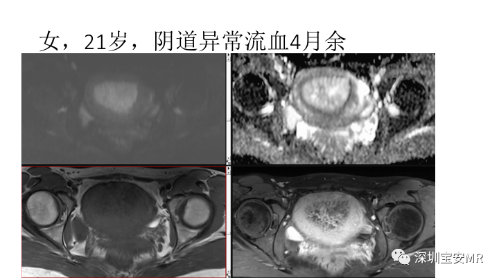 【PPT】子宫腔内病变MR