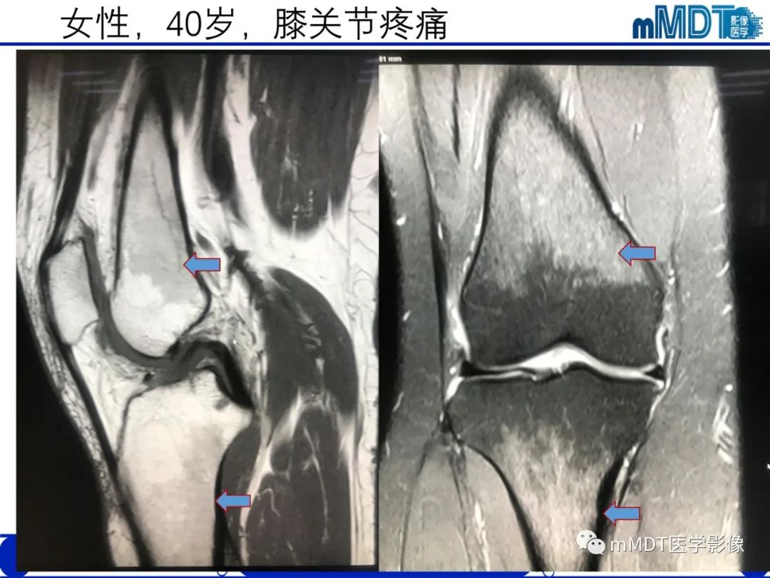 【PPT】骨髓的转化与逆转化