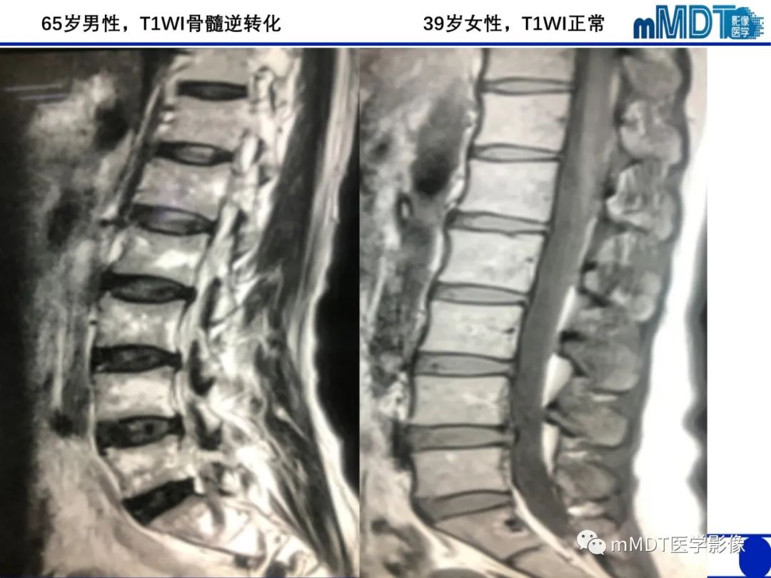 【PPT】骨髓的转化与逆转化