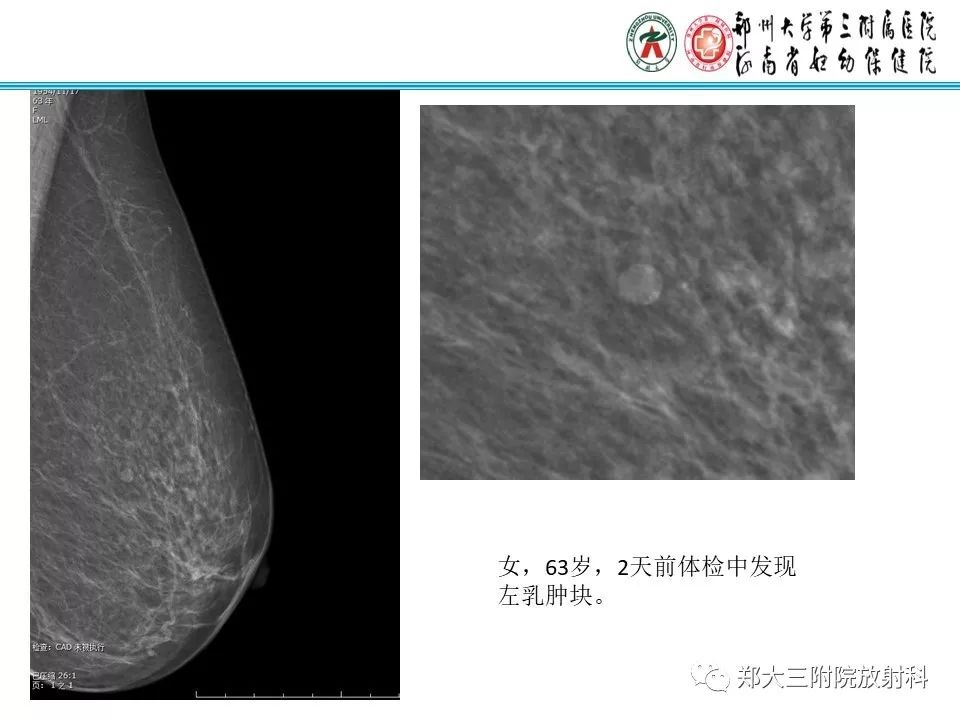 【PPT】乳腺囊肿的X线表现