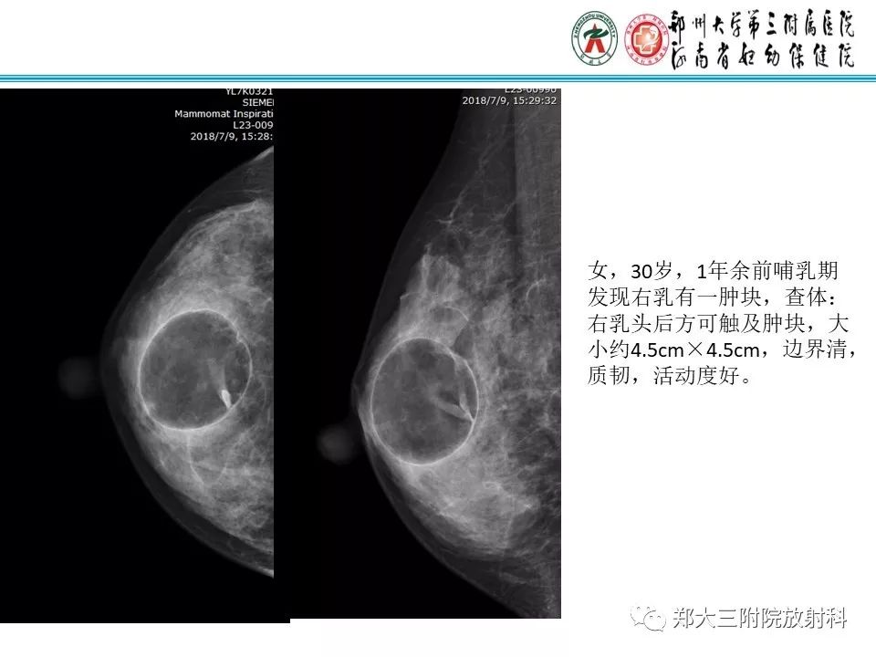 【PPT】乳腺囊肿的X线表现