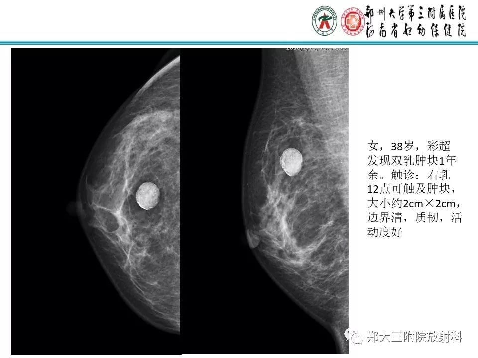 【PPT】乳腺囊肿的X线表现