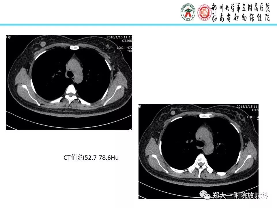 【PPT】乳腺囊肿的X线表现