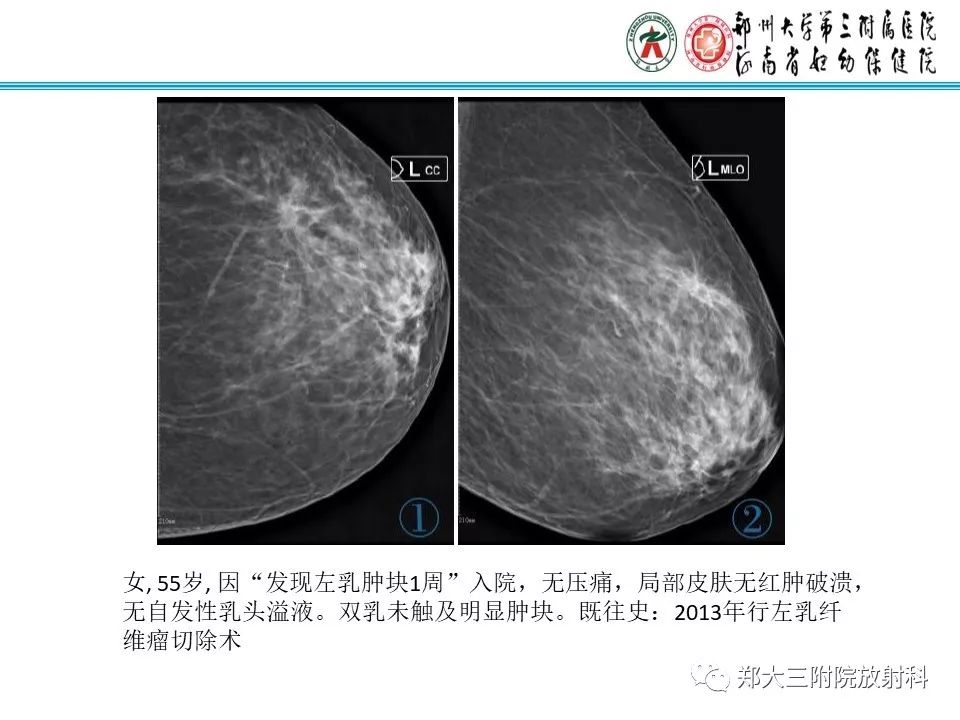 【PPT】乳腺囊肿的X线表现