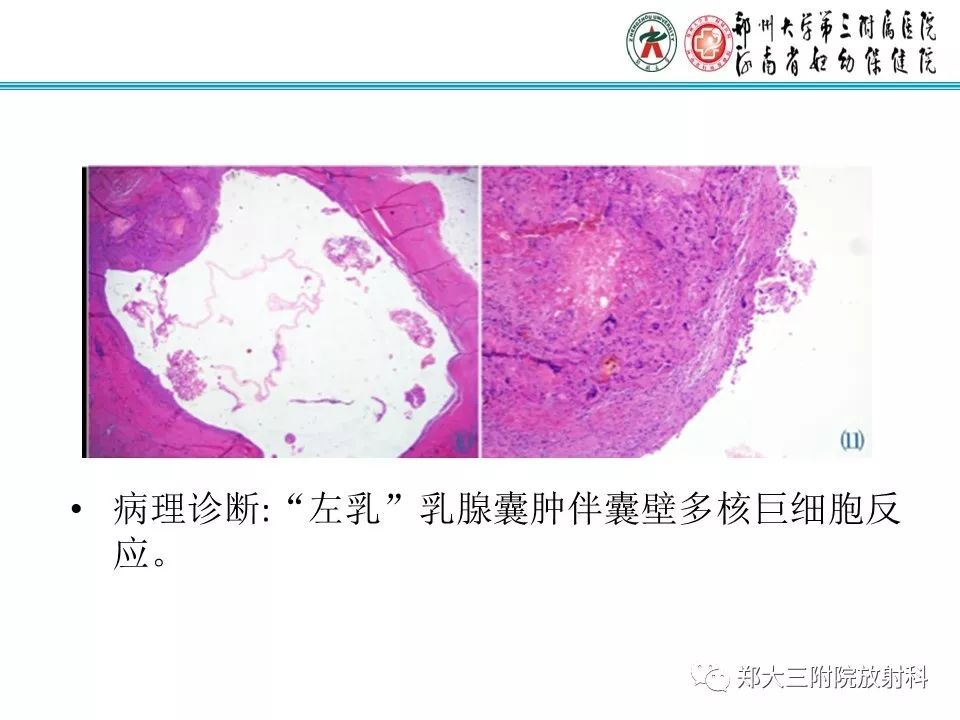 【PPT】乳腺囊肿的X线表现
