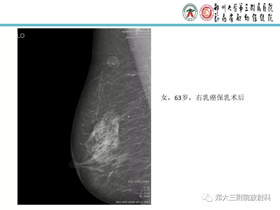 【PPT】乳腺囊肿的X线表现