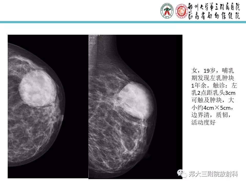 【PPT】乳腺囊肿的X线表现