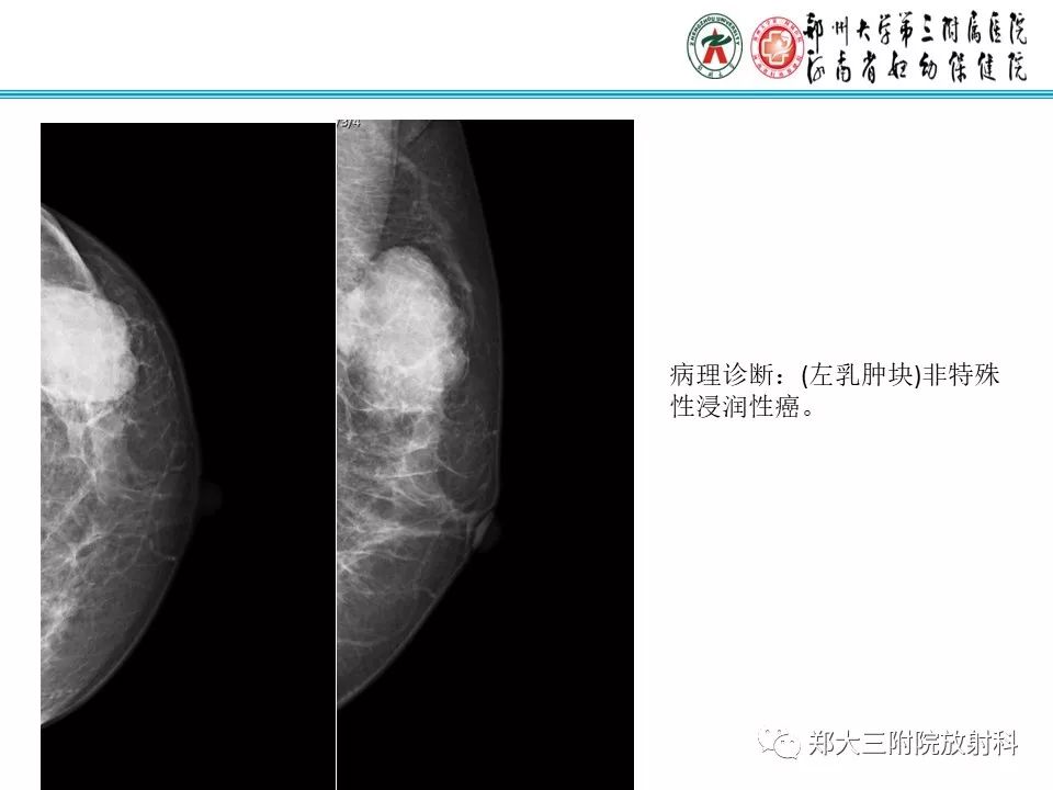 【PPT】乳腺囊肿的X线表现
