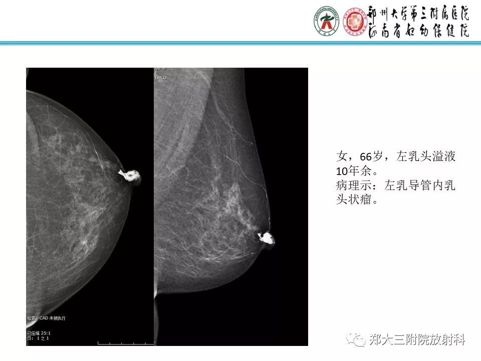 【PPT】乳腺囊肿的X线表现