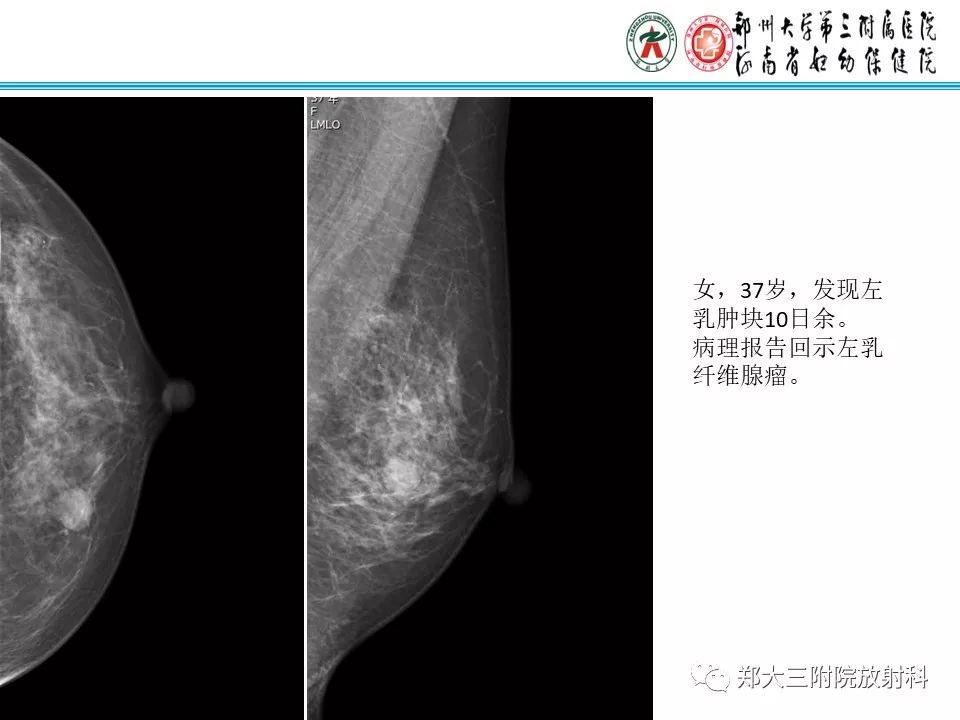 【PPT】乳腺囊肿的X线表现