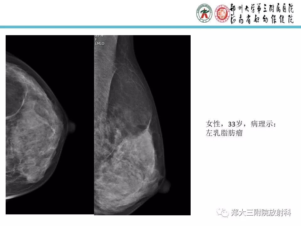 【PPT】乳腺囊肿的X线表现