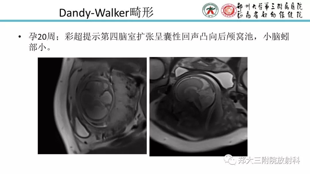 【PPT】胎儿小脑发育及常见疾病的MRI评估