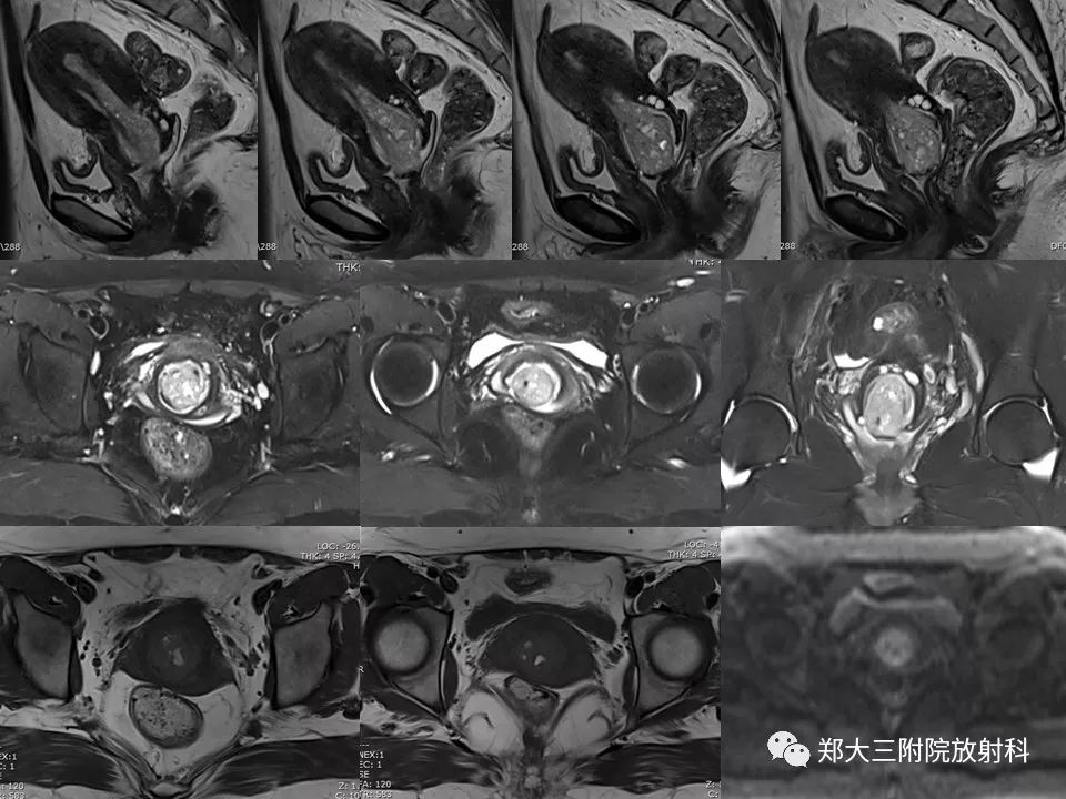 【病例】子宫腺肌瘤性息肉1例MR影像