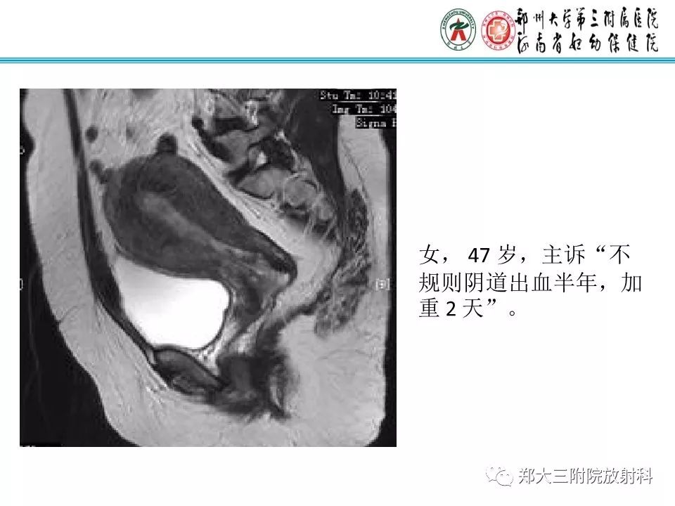 【病例】子宫腺肌瘤性息肉1例MR影像