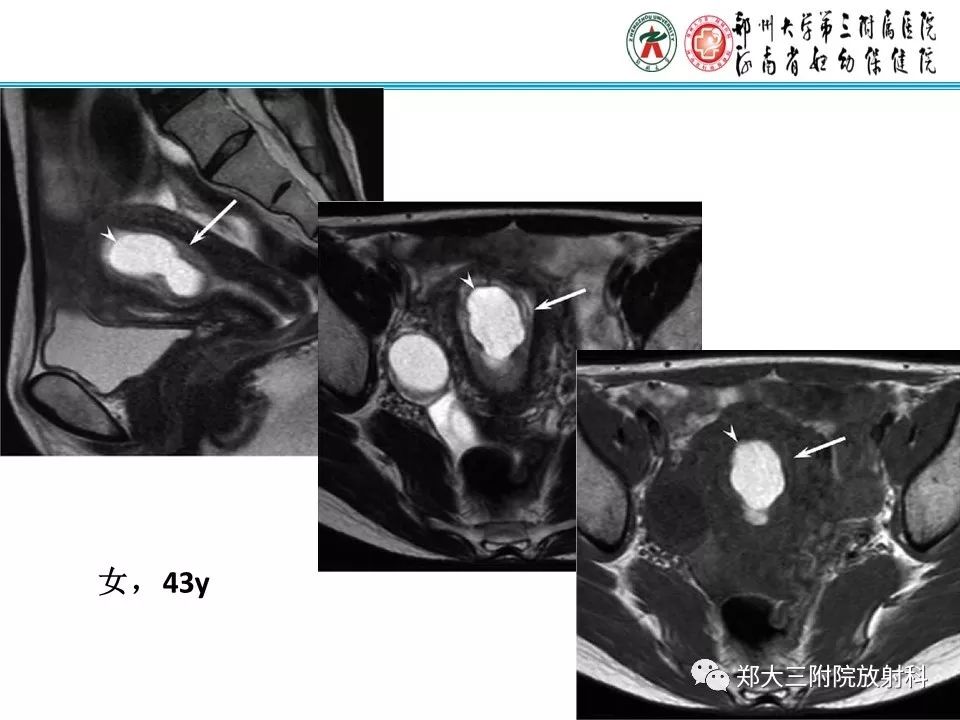 【病例】子宫腺肌瘤性息肉1例MR影像