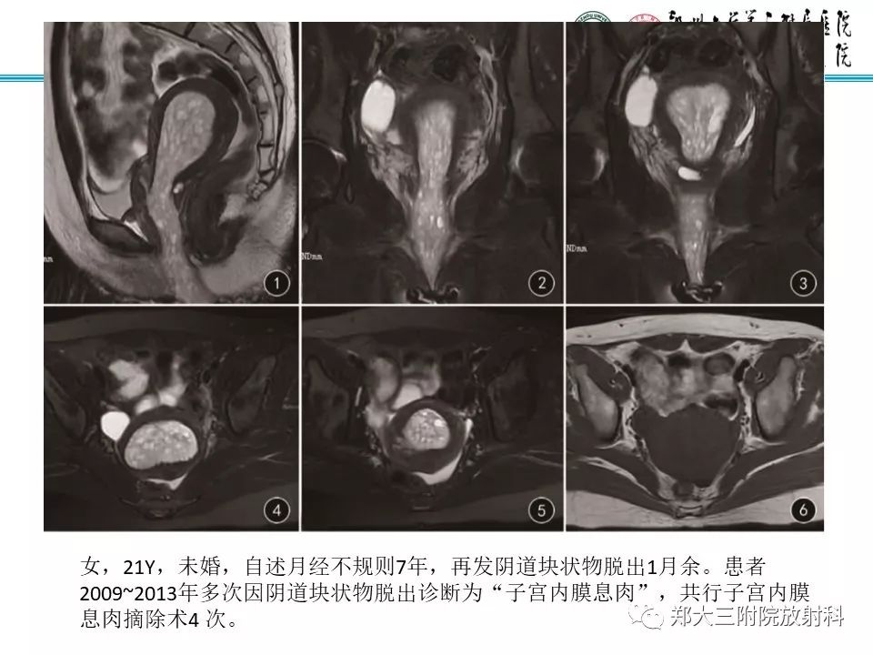 【病例】子宫腺肌瘤性息肉1例MR影像
