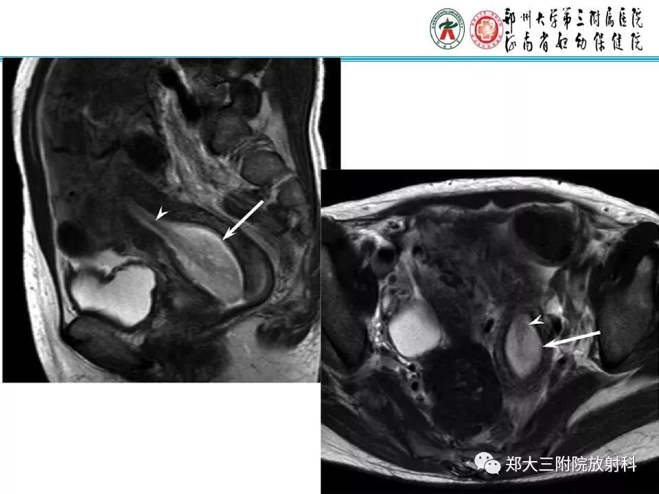 【病例】子宫腺肌瘤性息肉1例MR影像