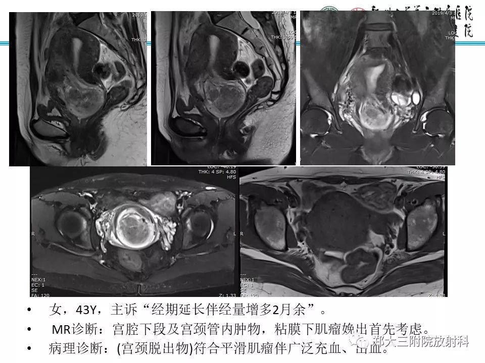 【病例】子宫腺肌瘤性息肉1例MR影像