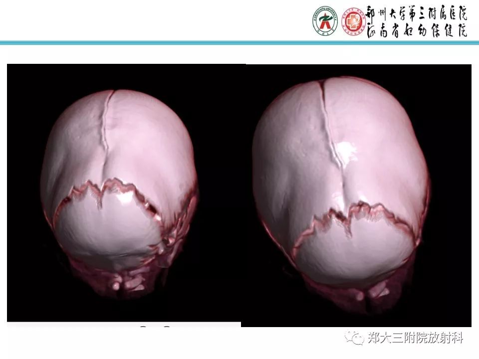 【PPT】颅缝早闭