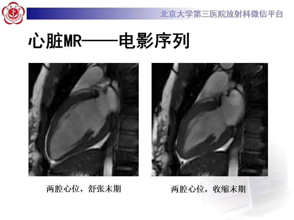 【病例】应激性心肌病1例MR影像