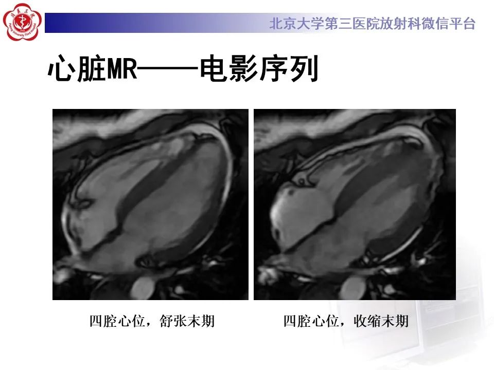 【病例】应激性心肌病1例MR影像