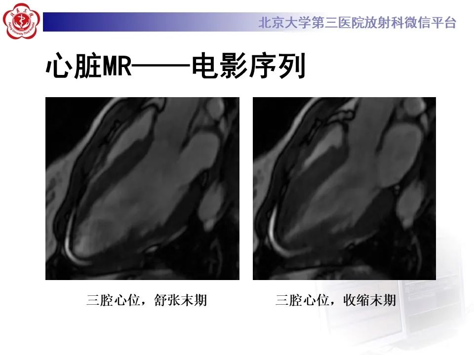 【病例】应激性心肌病1例MR影像