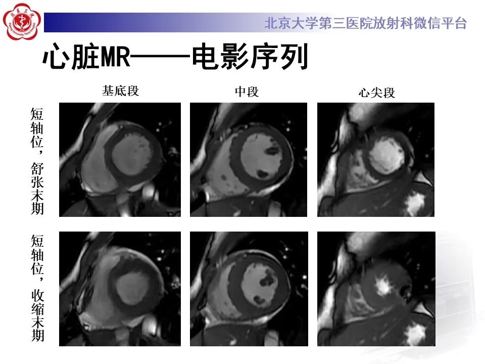 【病例】应激性心肌病1例MR影像