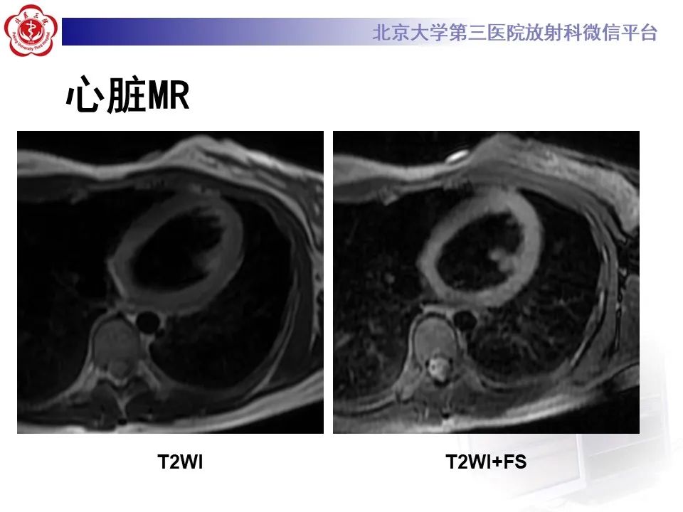 【病例】应激性心肌病1例MR影像