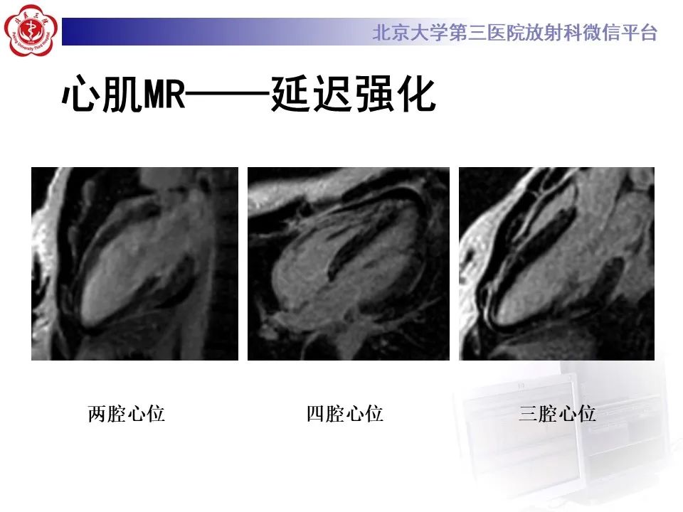 【病例】应激性心肌病1例MR影像