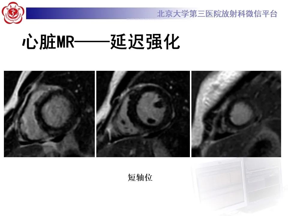 【病例】应激性心肌病1例MR影像