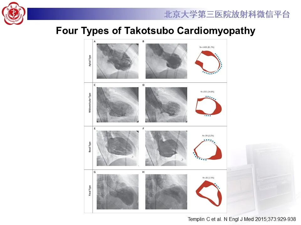 【病例】应激性心肌病1例MR影像