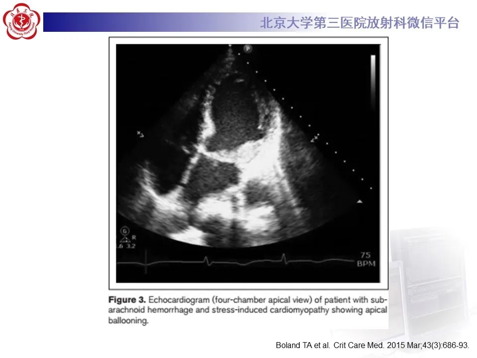 【病例】应激性心肌病1例MR影像