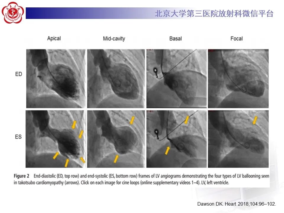 【病例】应激性心肌病1例MR影像