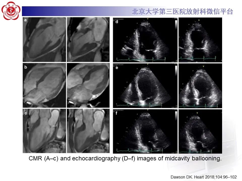 【病例】应激性心肌病1例MR影像