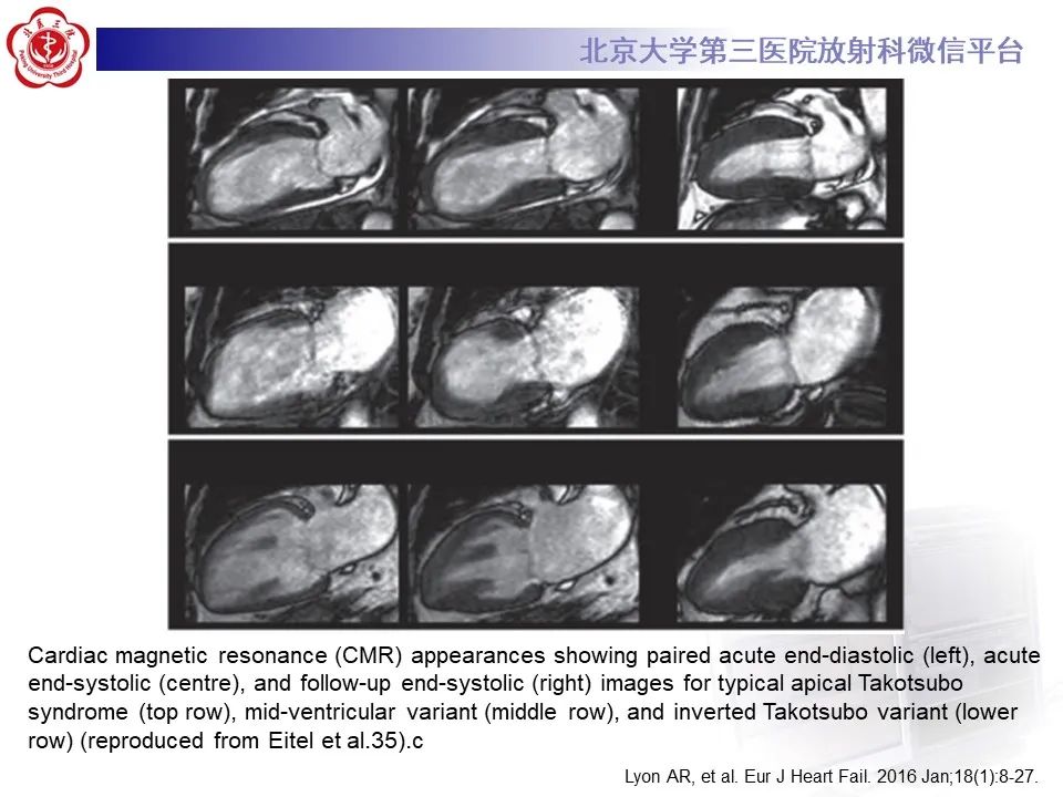 【病例】应激性心肌病1例MR影像