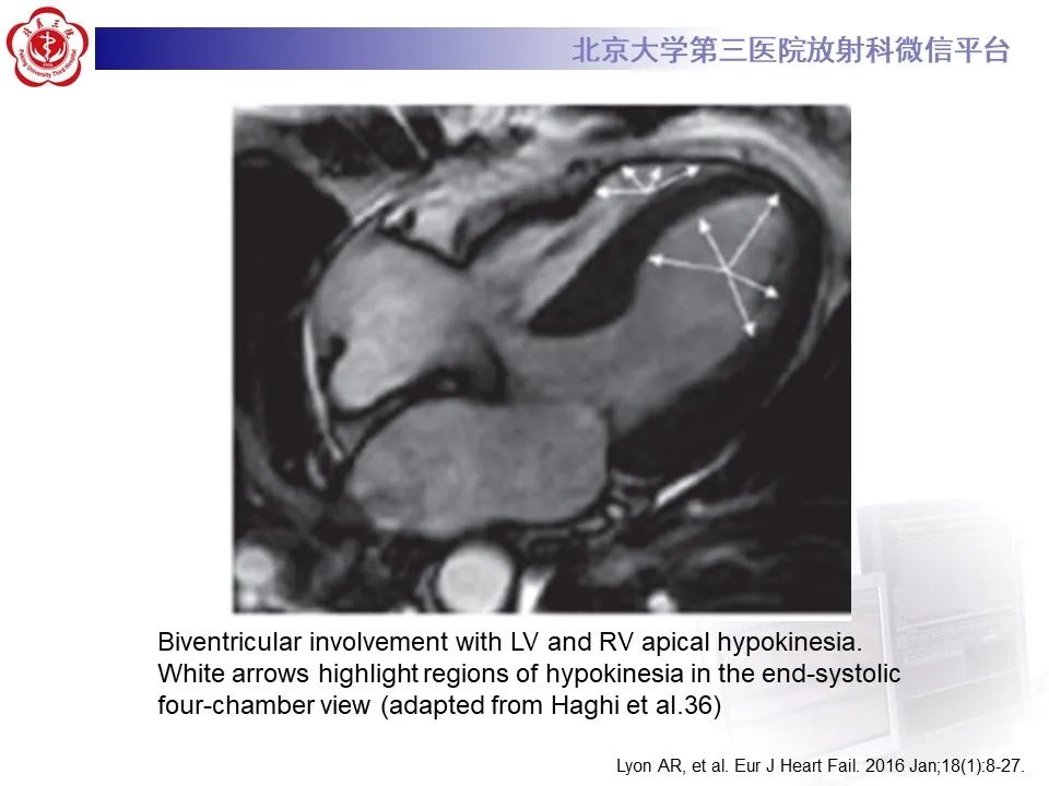 【病例】应激性心肌病1例MR影像