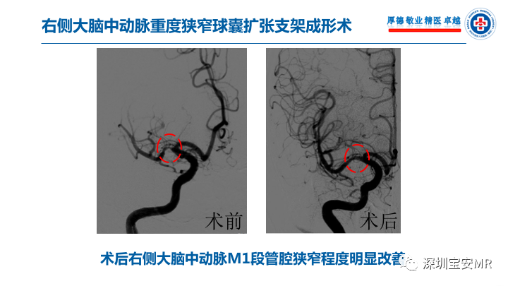 【病例】卒中诊治利剑—MR血管壁技术评估病例展示 【病例】卒中诊治利剑—MR血管壁技术评估病例展示