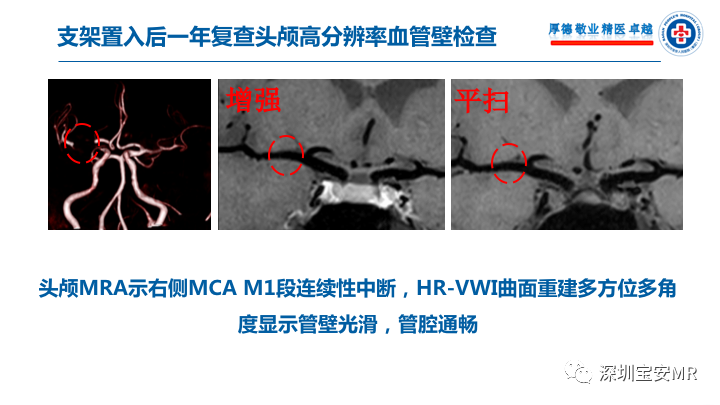 【病例】卒中诊治利剑—MR血管壁技术评估病例展示 【病例】卒中诊治利剑—MR血管壁技术评估病例展示