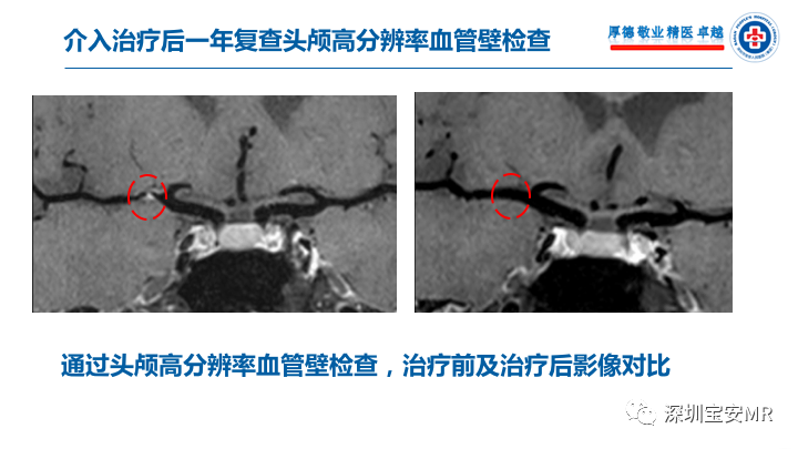 【病例】卒中诊治利剑—MR血管壁技术评估病例展示 【病例】卒中诊治利剑—MR血管壁技术评估病例展示