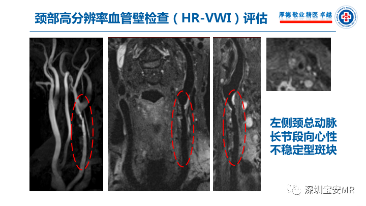 【病例】卒中诊治利剑—MR血管壁技术评估病例展示 【病例】卒中诊治利剑—MR血管壁技术评估病例展示
