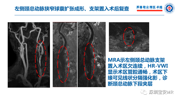 【病例】卒中诊治利剑—MR血管壁技术评估病例展示 【病例】卒中诊治利剑—MR血管壁技术评估病例展示