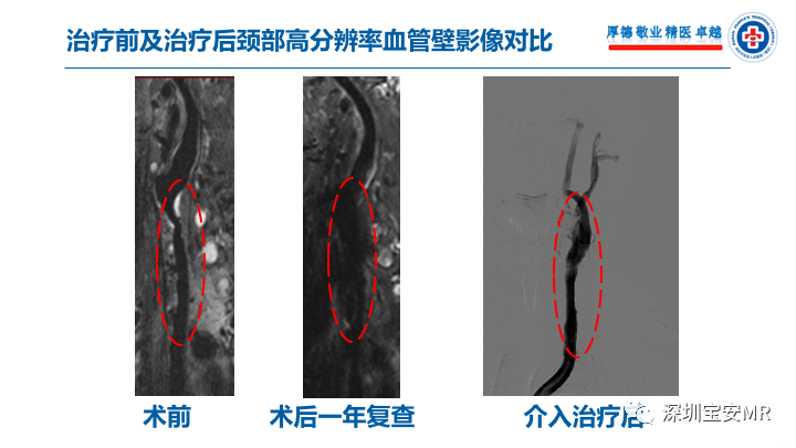 【病例】卒中诊治利剑—MR血管壁技术评估病例展示 【病例】卒中诊治利剑—MR血管壁技术评估病例展示