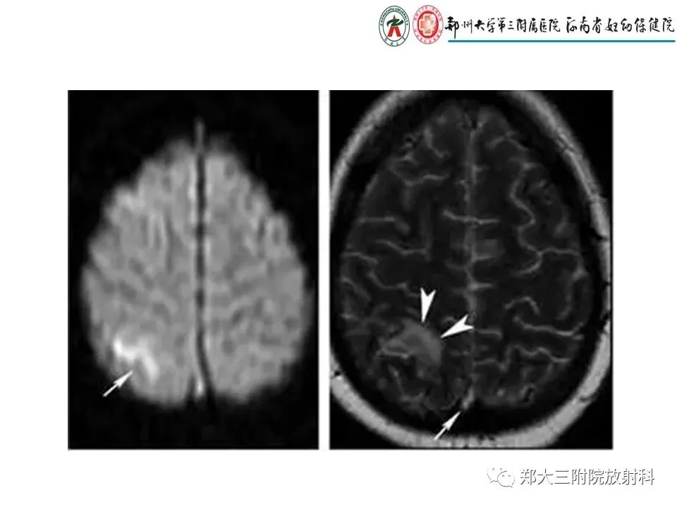 【PPT】静脉窦血栓的影像诊断及误区