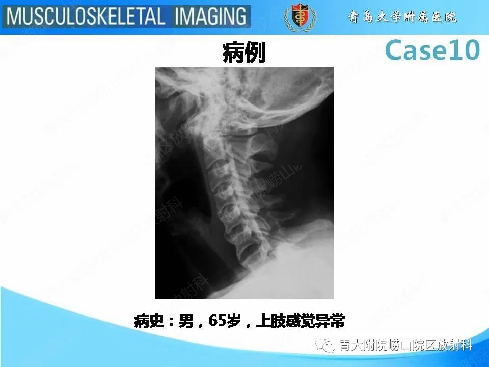 【PPT】后纵韧带骨化症