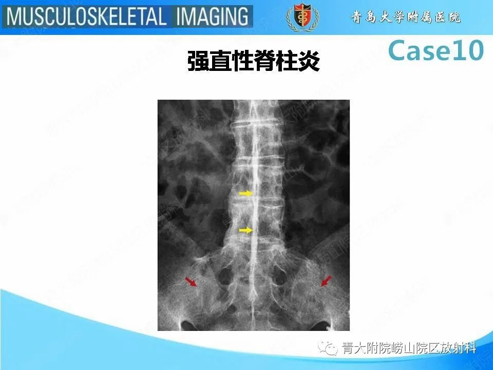 【PPT】后纵韧带骨化症