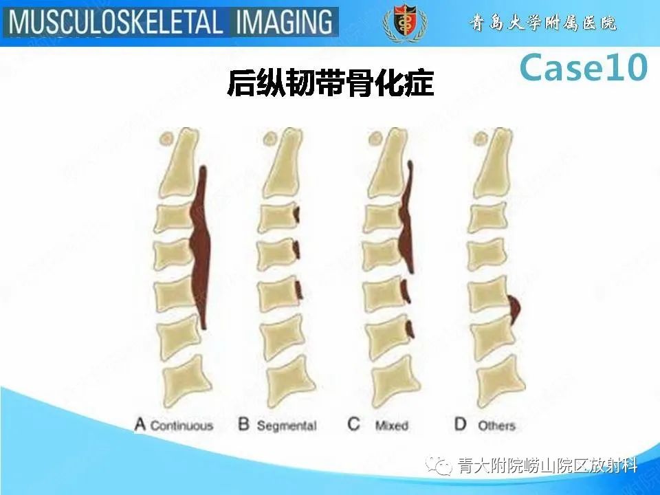 【PPT】后纵韧带骨化症
