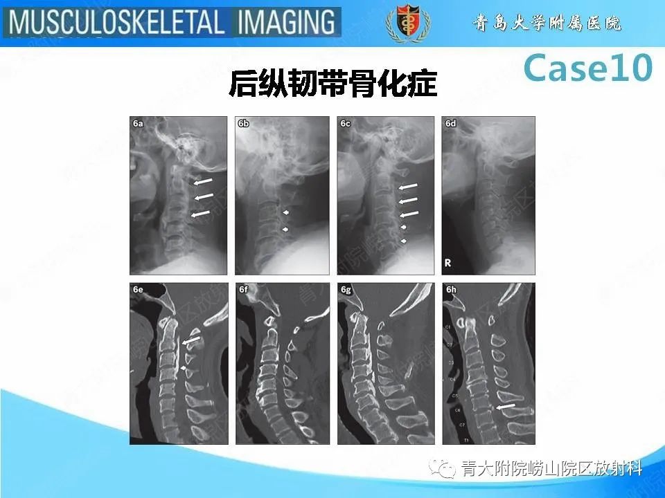 【PPT】后纵韧带骨化症