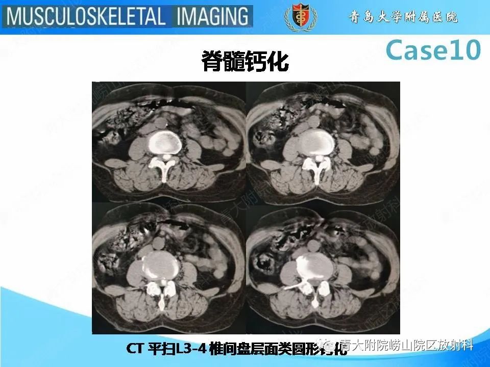 【PPT】后纵韧带骨化症