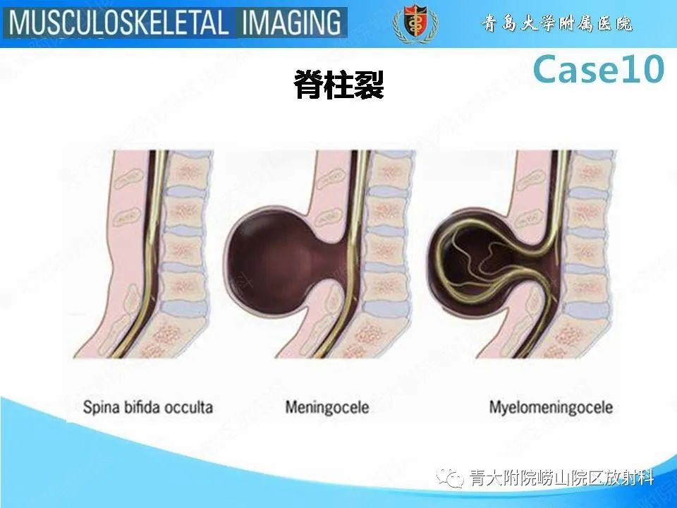 【PPT】后纵韧带骨化症