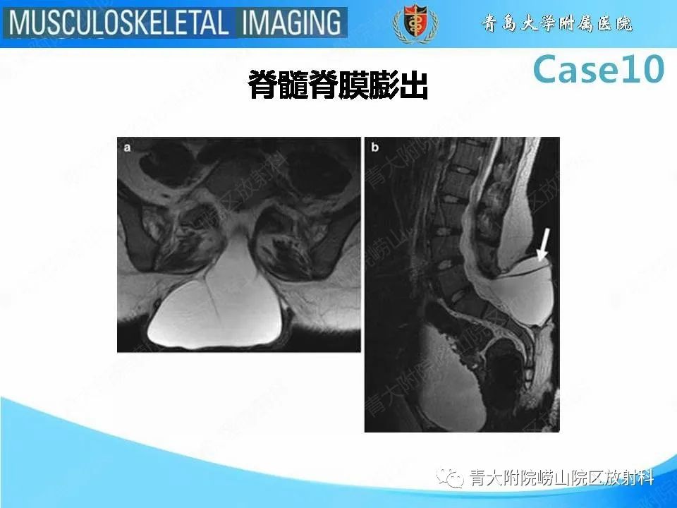【PPT】后纵韧带骨化症